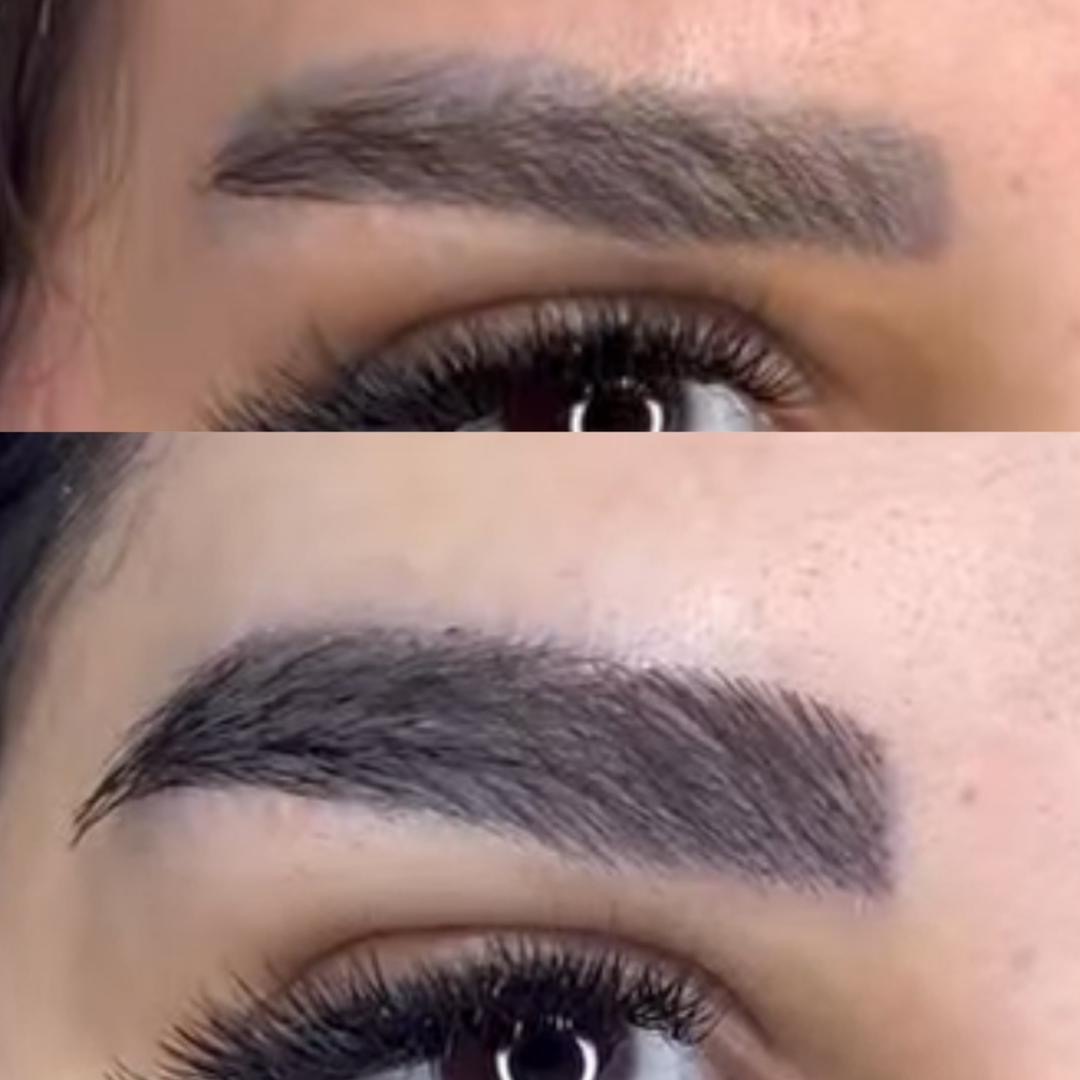 قبل و حدود شش ماه بعد از کاشت ابرو با روش FUT و میکروگرافت، نمونه سه