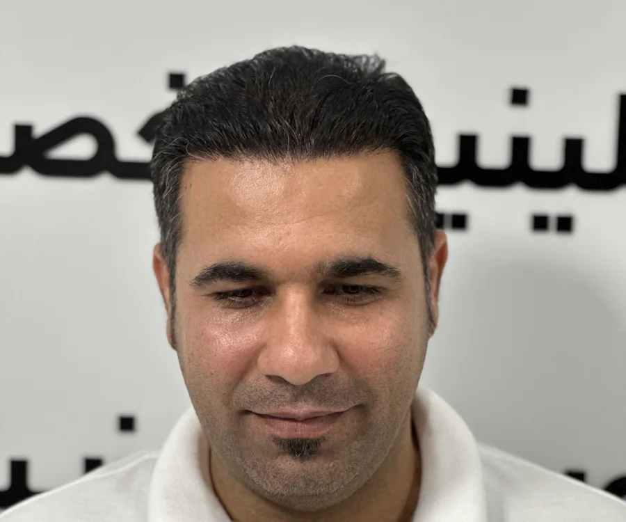 نتیجه رشد مو پس از کاشت، نمونه واقعی کلینیک آرا
