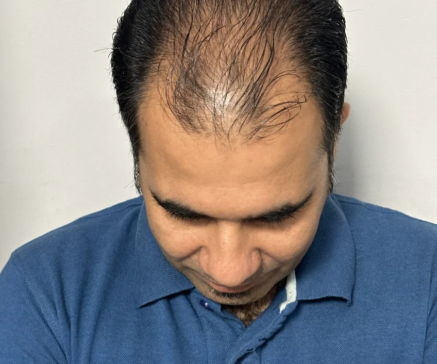 کم‌پشتی مو پیش از کاشت، نمونه واقعی کلینیک آرا