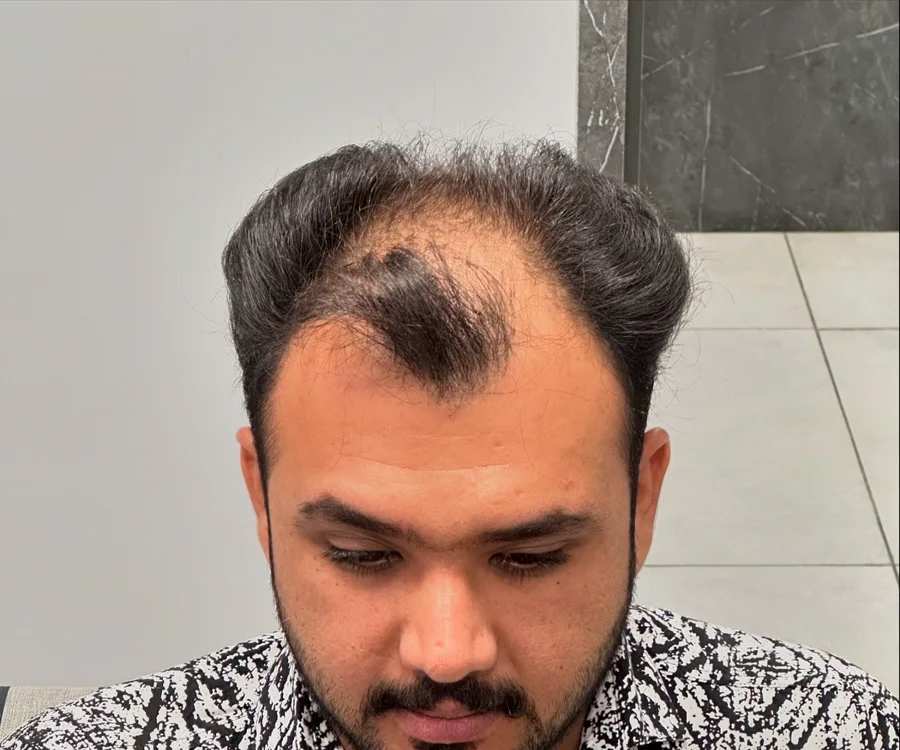 نمای پیش از کاشت مو با روش Micro FIT، نمونه واقعی کلینیک آرا