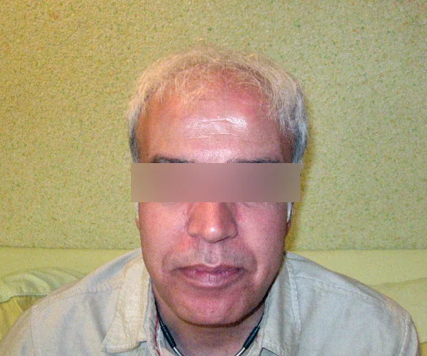 نمای قبل از کاشت مو، نمونه آرشیوی شماره یک
