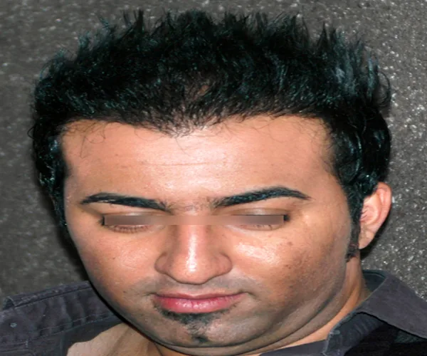 نمای بعد از کاشت مو، نمونه آرشیوی شماره سه