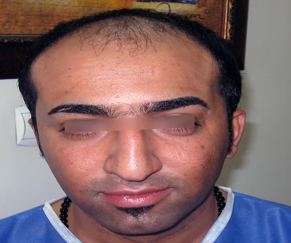 نمای قبل از کاشت مو، نمونه آرشیوی شماره سه