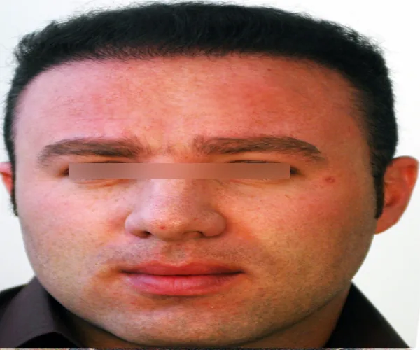 تصویر بعد کاشت مو پرونده آرشیوی شماره ۵