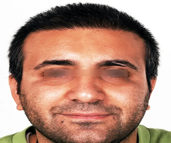 تصویر بعد کاشت مو پرونده آرشیوی شماره ۶