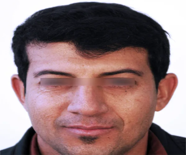 تصویر بعد کاشت مو پرونده آرشیوی شماره ۷