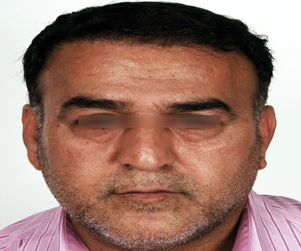 تصویر بعد کاشت مو پرونده آرشیوی شماره ۸