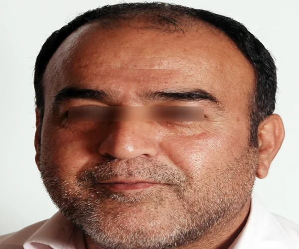 تصویر قبل کاشت مو پرونده آرشیوی شماره ۸